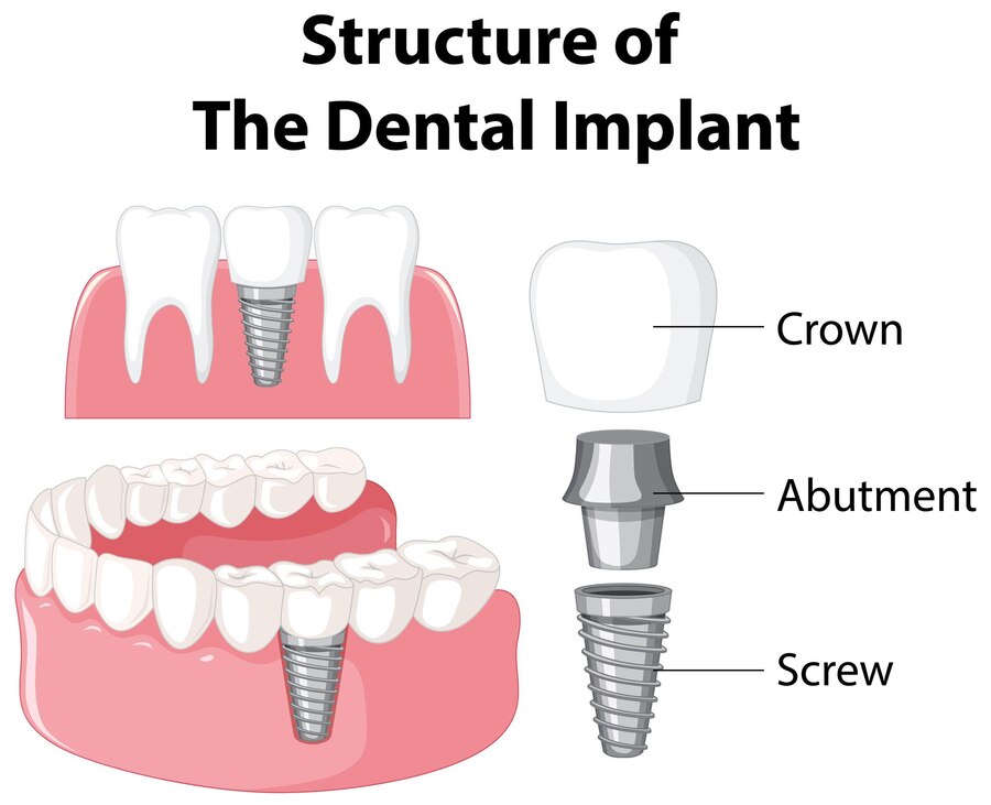 Jakie są zalety implantów zębowych?